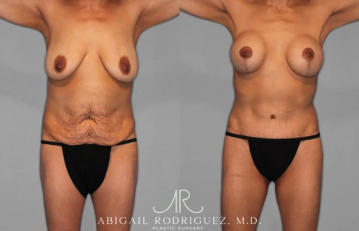 Before & After Tummy Tuck Case 259145 View 1 View in Houston, TX