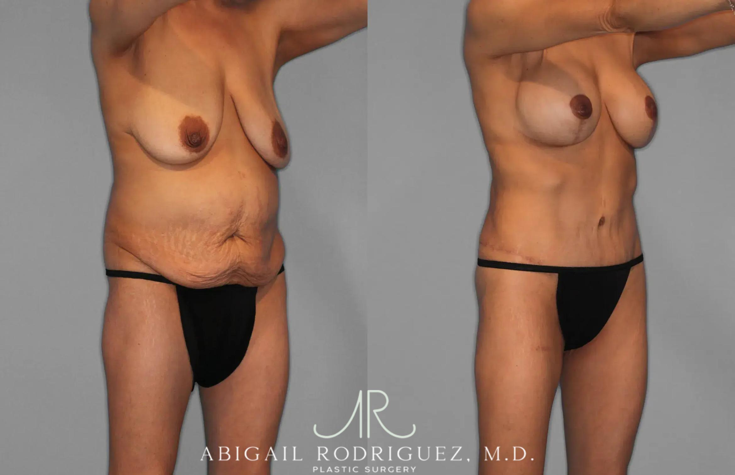 Before & After Tummy Tuck Case 259145 View 10 View in Houston, TX