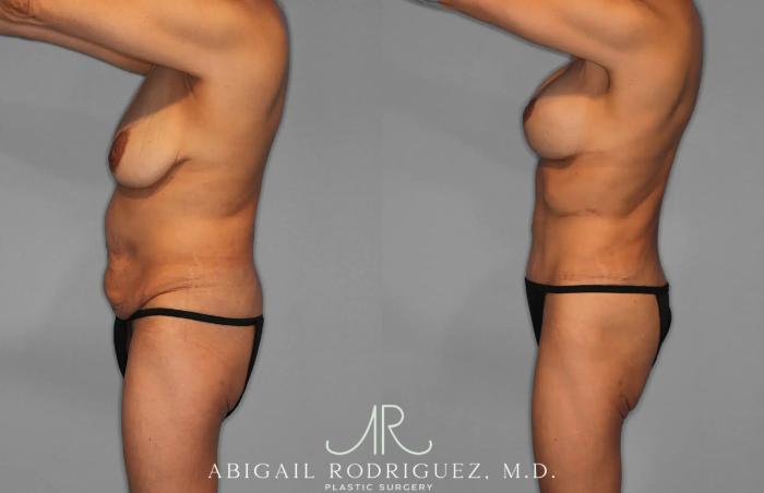 Before & After Tummy Tuck Case 259145 View 3 View in Houston, TX