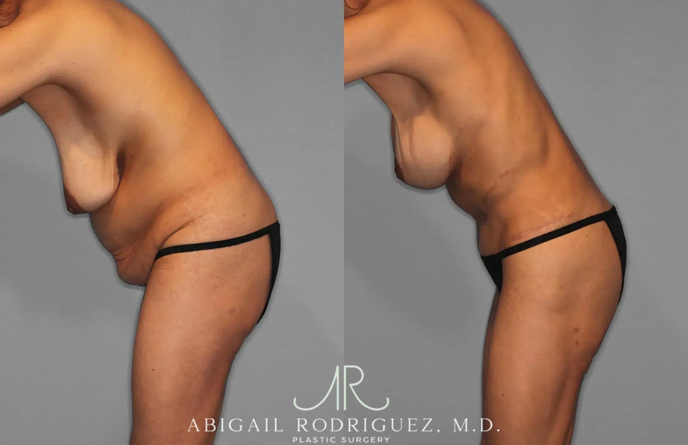 Before & After Tummy Tuck Case 259145 View 4 View in Houston, TX