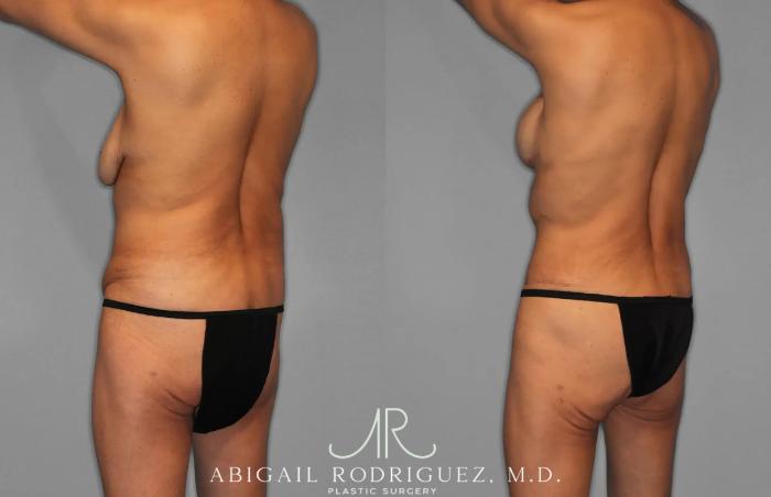 Before & After Tummy Tuck Case 259145 View 5 View in Houston, TX