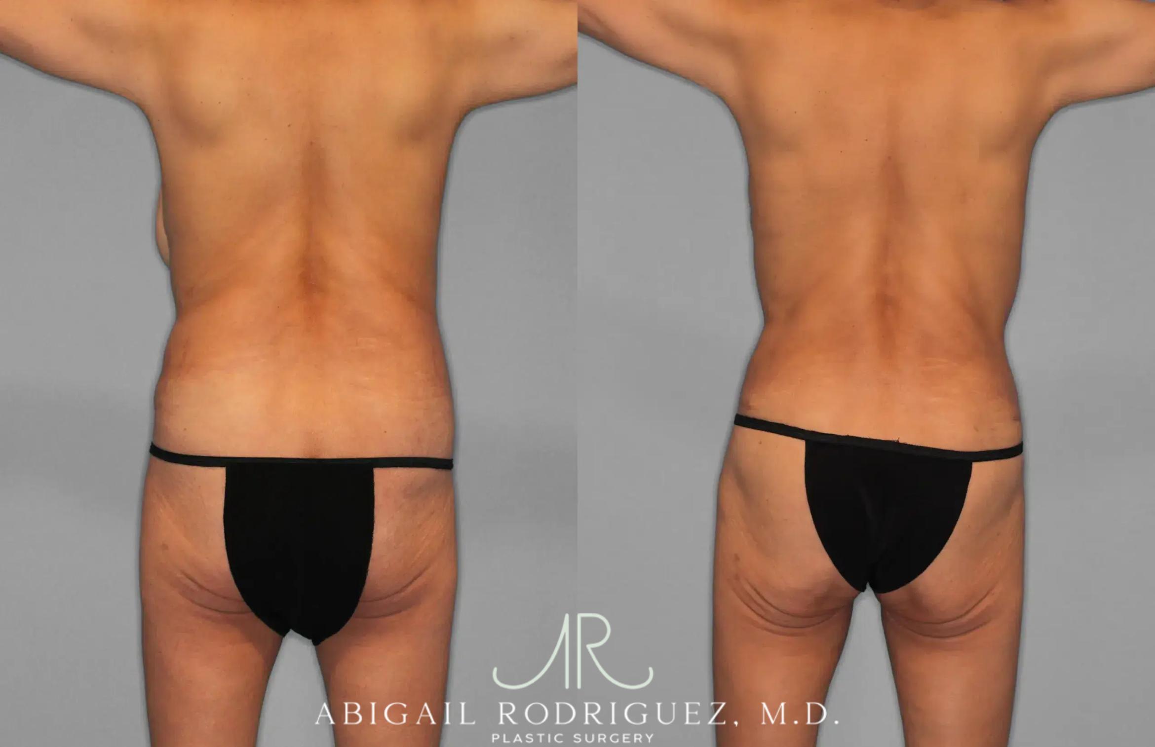Before & After Tummy Tuck Case 259145 View 6 View in Houston, TX