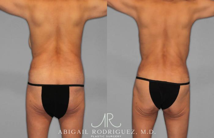 Before & After Tummy Tuck Case 259145 View 6 View in Houston, TX