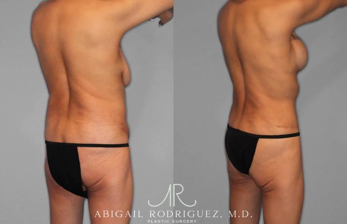 Before & After Tummy Tuck Case 259145 View 7 View in Houston, TX