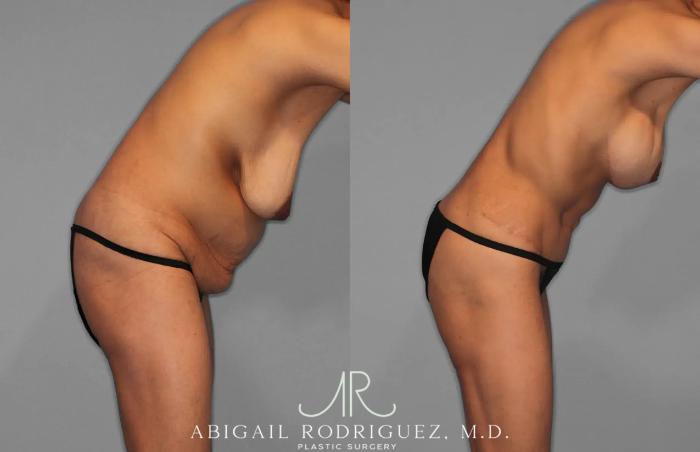 Before & After Tummy Tuck Case 259145 View 8 View in Houston, TX