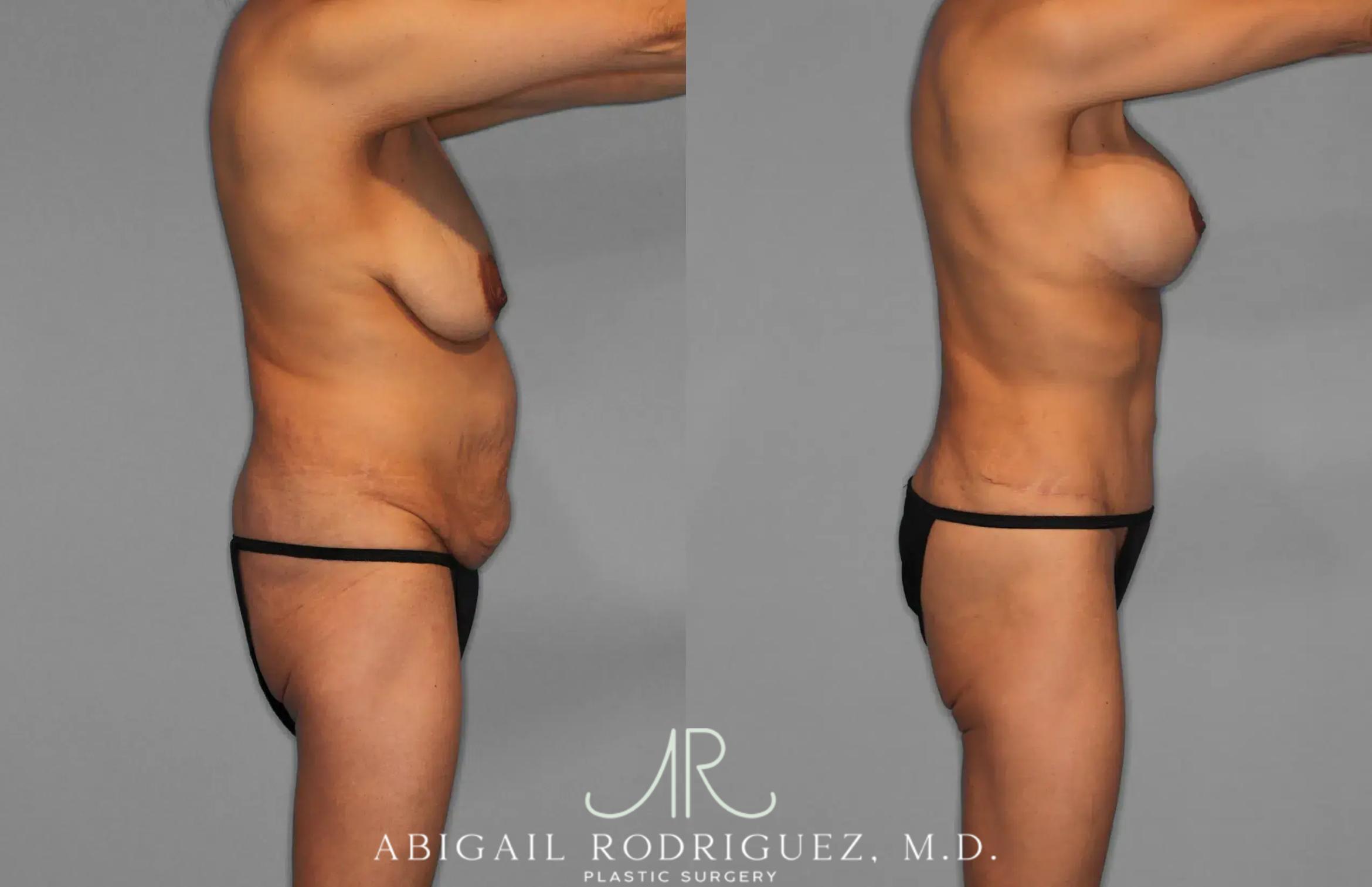 Before & After Tummy Tuck Case 259145 View 9 View in Houston, TX