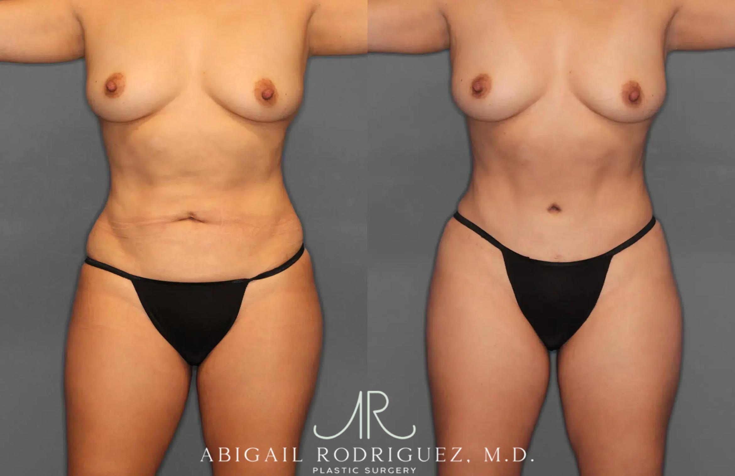Before & After Tummy Tuck Case 259165 View 1 View in Houston, TX