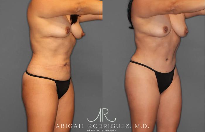 Before & After Tummy Tuck Case 259165 View 10 View in Houston, TX