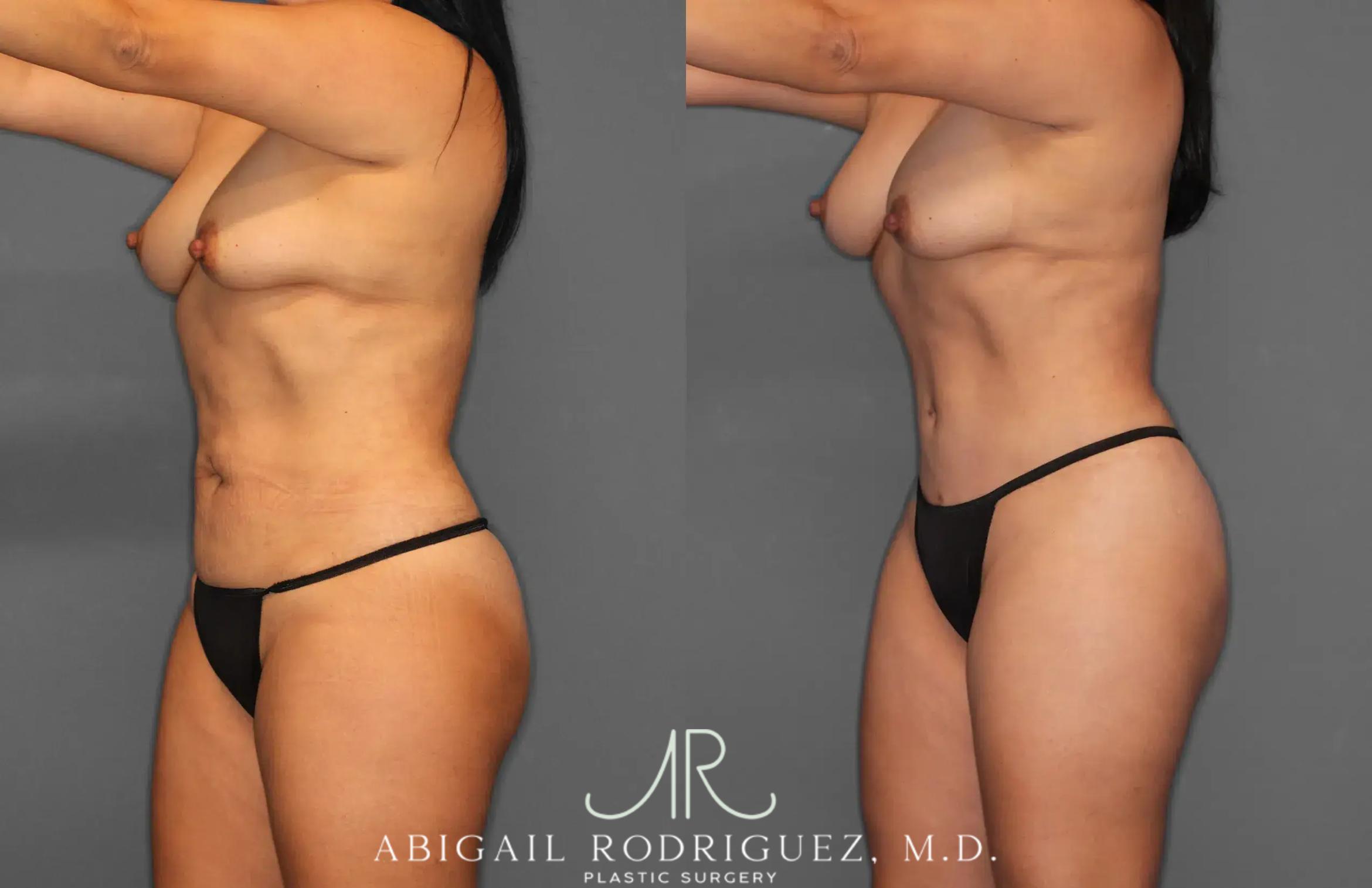 Before & After Tummy Tuck Case 259165 View 2 View in Houston, TX