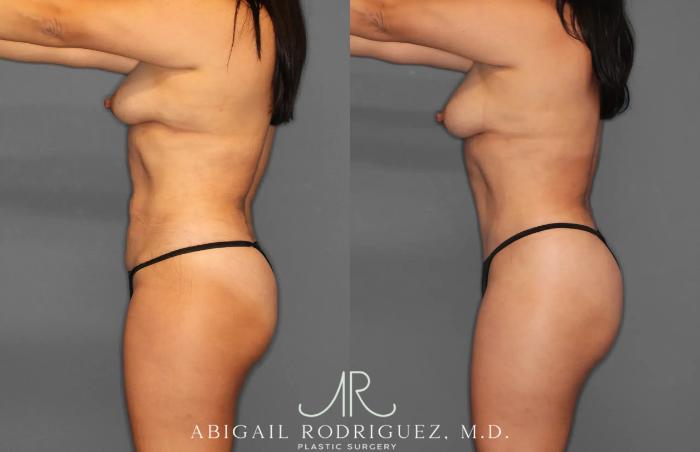 Before & After Tummy Tuck Case 259165 View 3 View in Houston, TX