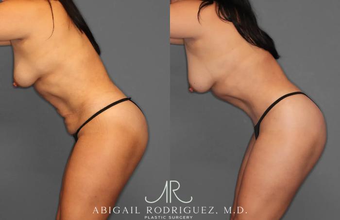 Before & After Tummy Tuck Case 259165 View 4 View in Houston, TX