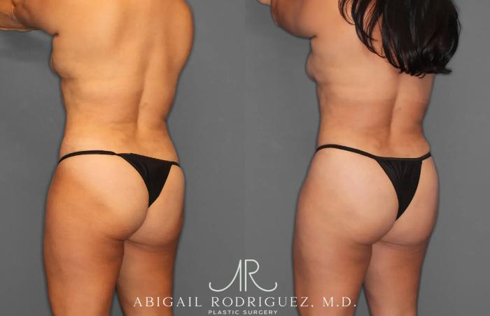 Before & After Tummy Tuck Case 259165 View 5 View in Houston, TX