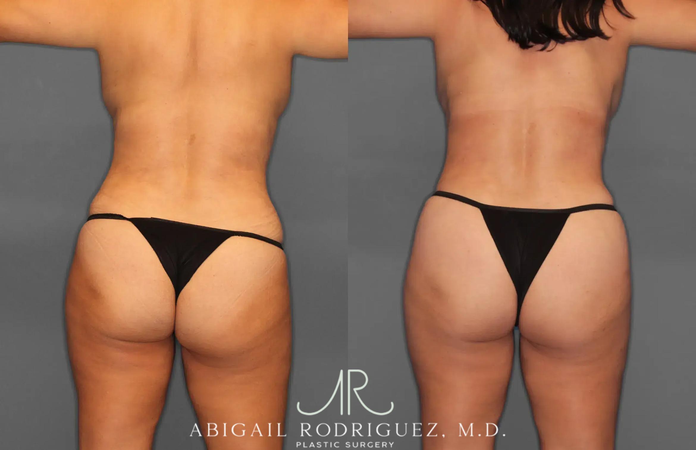 Before & After Tummy Tuck Case 259165 View 6 View in Houston, TX