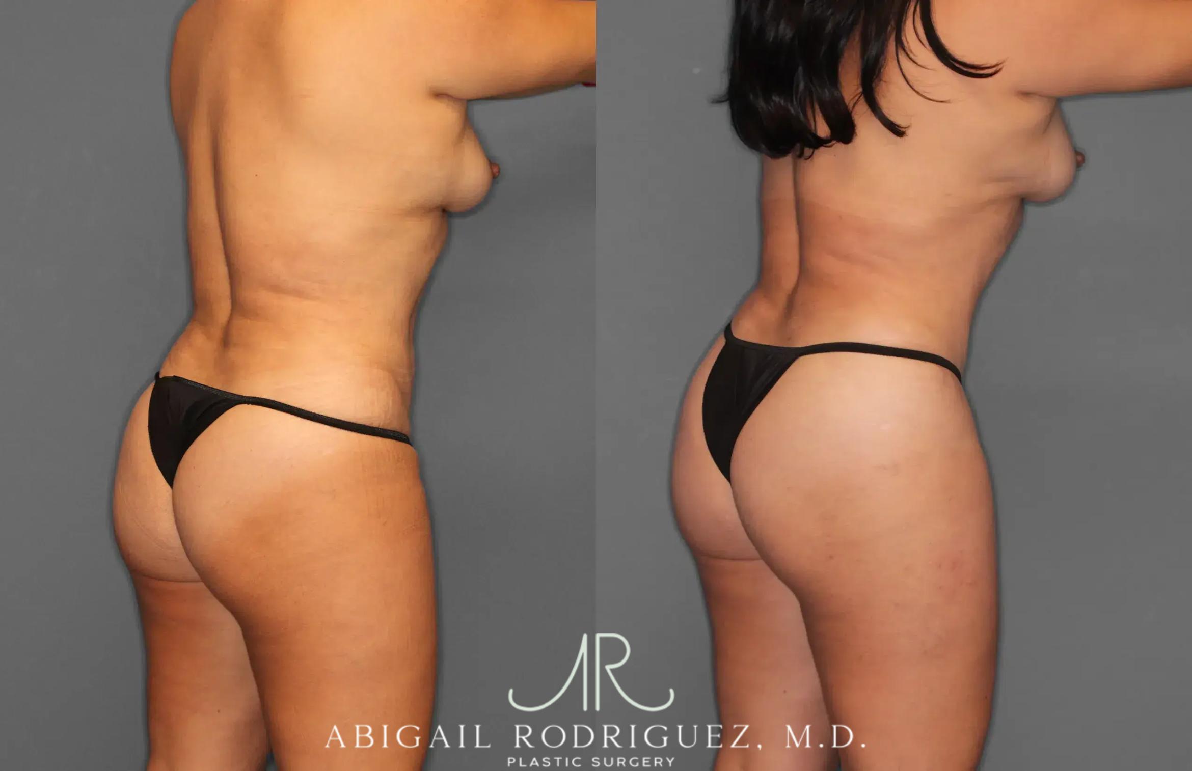 Before & After Tummy Tuck Case 259165 View 7 View in Houston, TX