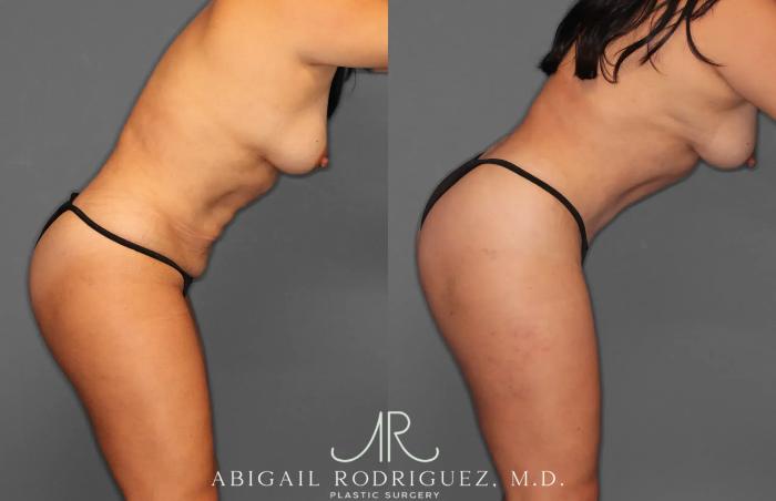 Before & After Tummy Tuck Case 259165 View 8 View in Houston, TX