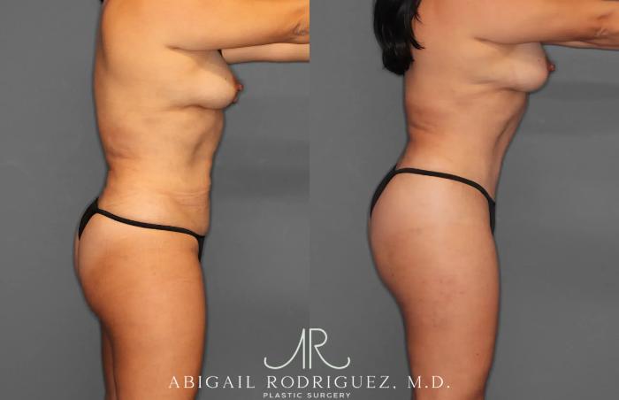 Before & After Tummy Tuck Case 259165 View 9 View in Houston, TX