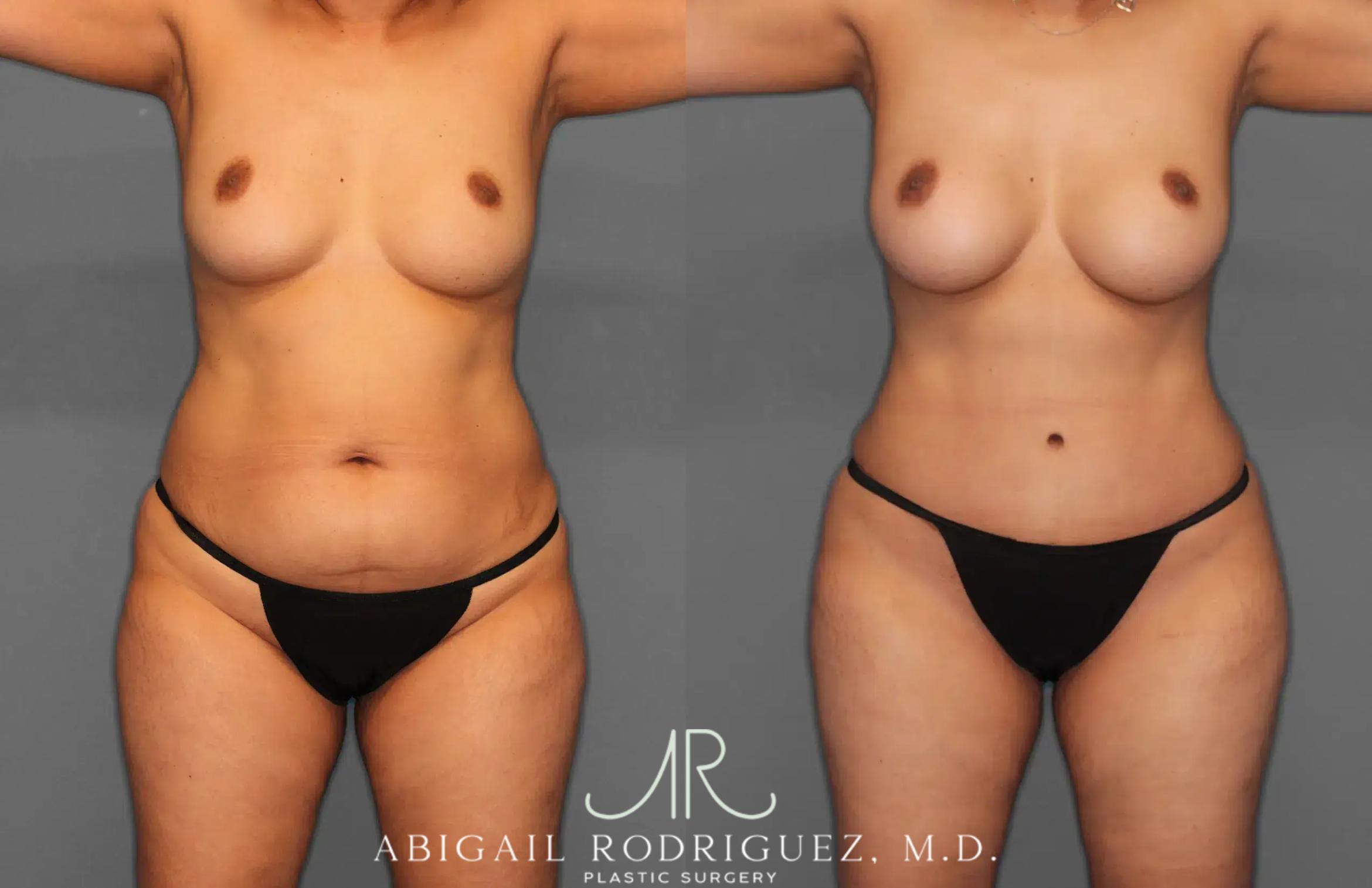 Before & After Tummy Tuck Case 259179 View 1 View in Houston, TX