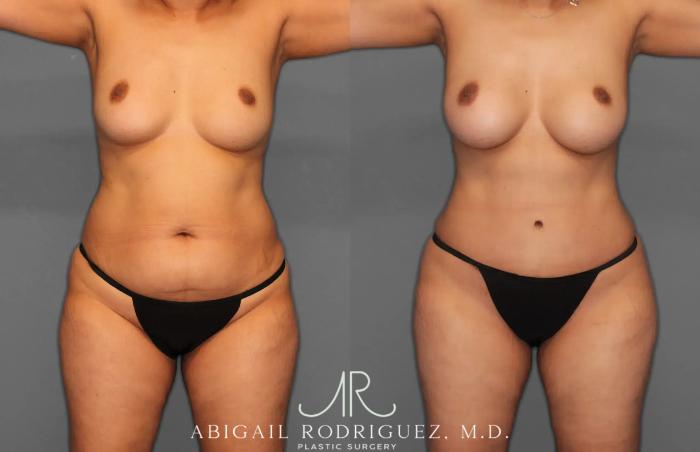 Before & After Tummy Tuck Case 259179 View 1 View in Houston, TX