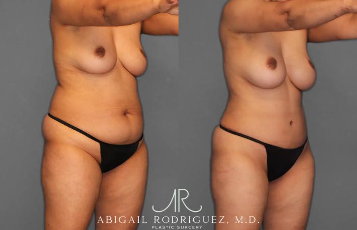 Before & After Tummy Tuck Case 259179 View 10 View in Houston, TX