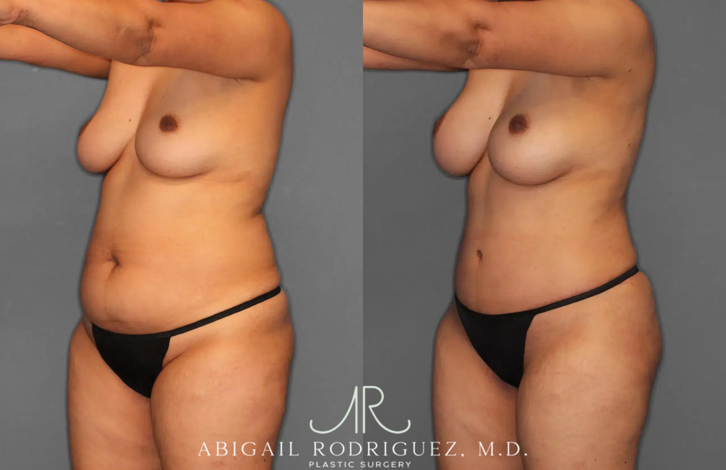Before & After Tummy Tuck Case 259179 View 2 View in Houston, TX