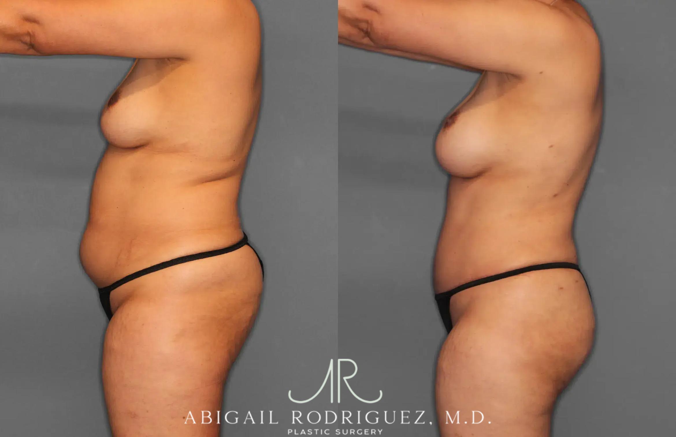 Before & After Tummy Tuck Case 259179 View 3 View in Houston, TX