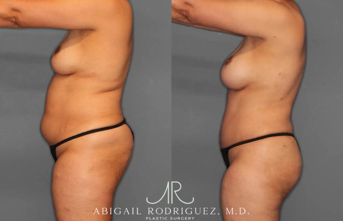 Before & After Tummy Tuck Case 259179 View 3 View in Houston, TX