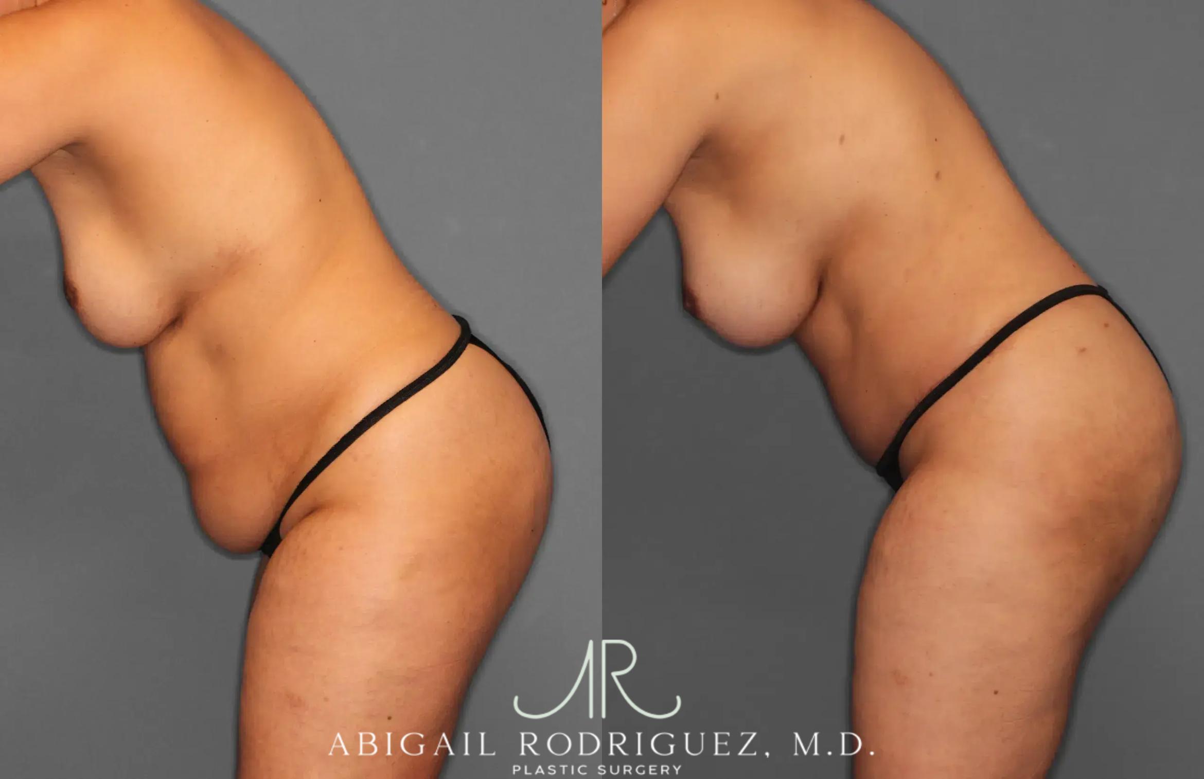 Before & After Tummy Tuck Case 259179 View 4 View in Houston, TX