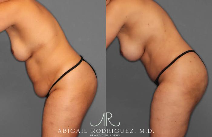 Before & After Tummy Tuck Case 259179 View 4 View in Houston, TX