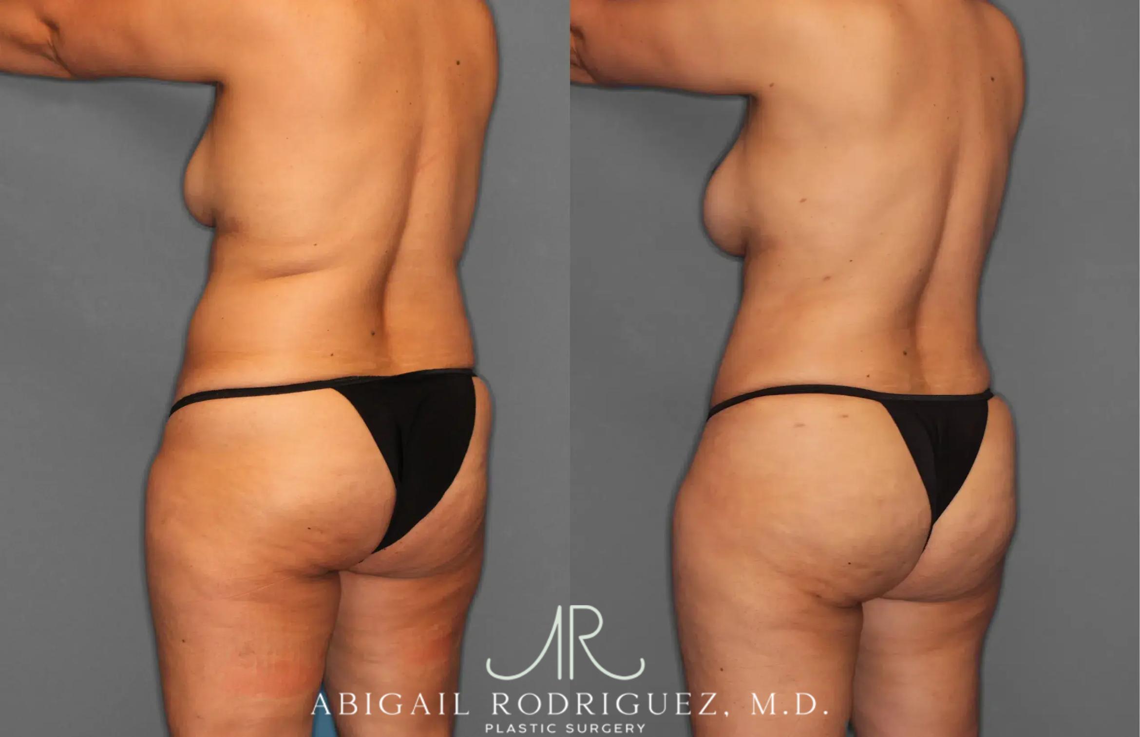 Before & After Tummy Tuck Case 259179 View 5 View in Houston, TX