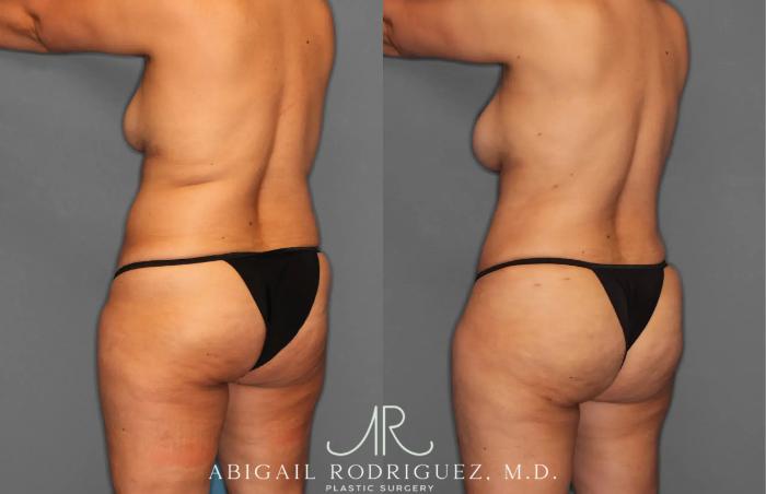 Before & After Tummy Tuck Case 259179 View 5 View in Houston, TX