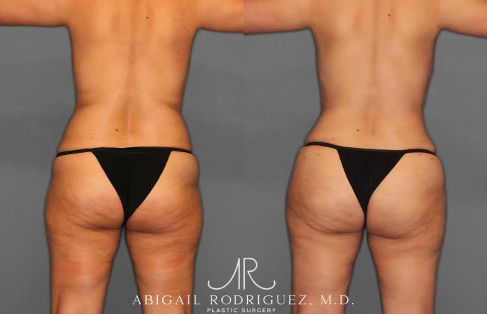 Before & After Tummy Tuck Case 259179 View 6 View in Houston, TX