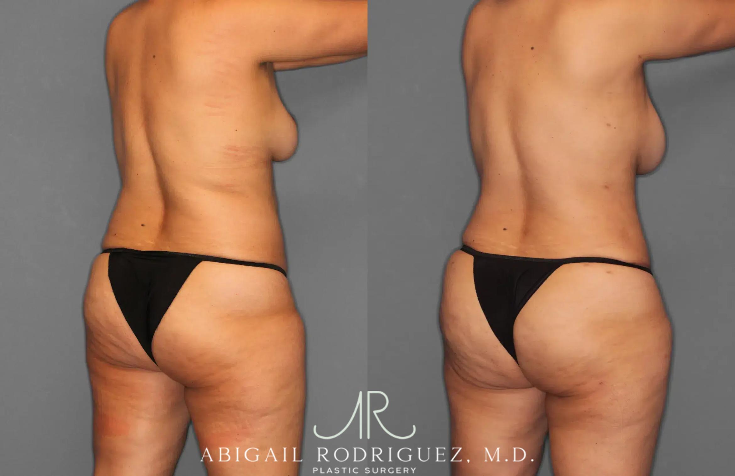 Before & After Tummy Tuck Case 259179 View 7 View in Houston, TX