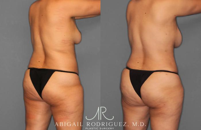 Before & After Tummy Tuck Case 259179 View 7 View in Houston, TX