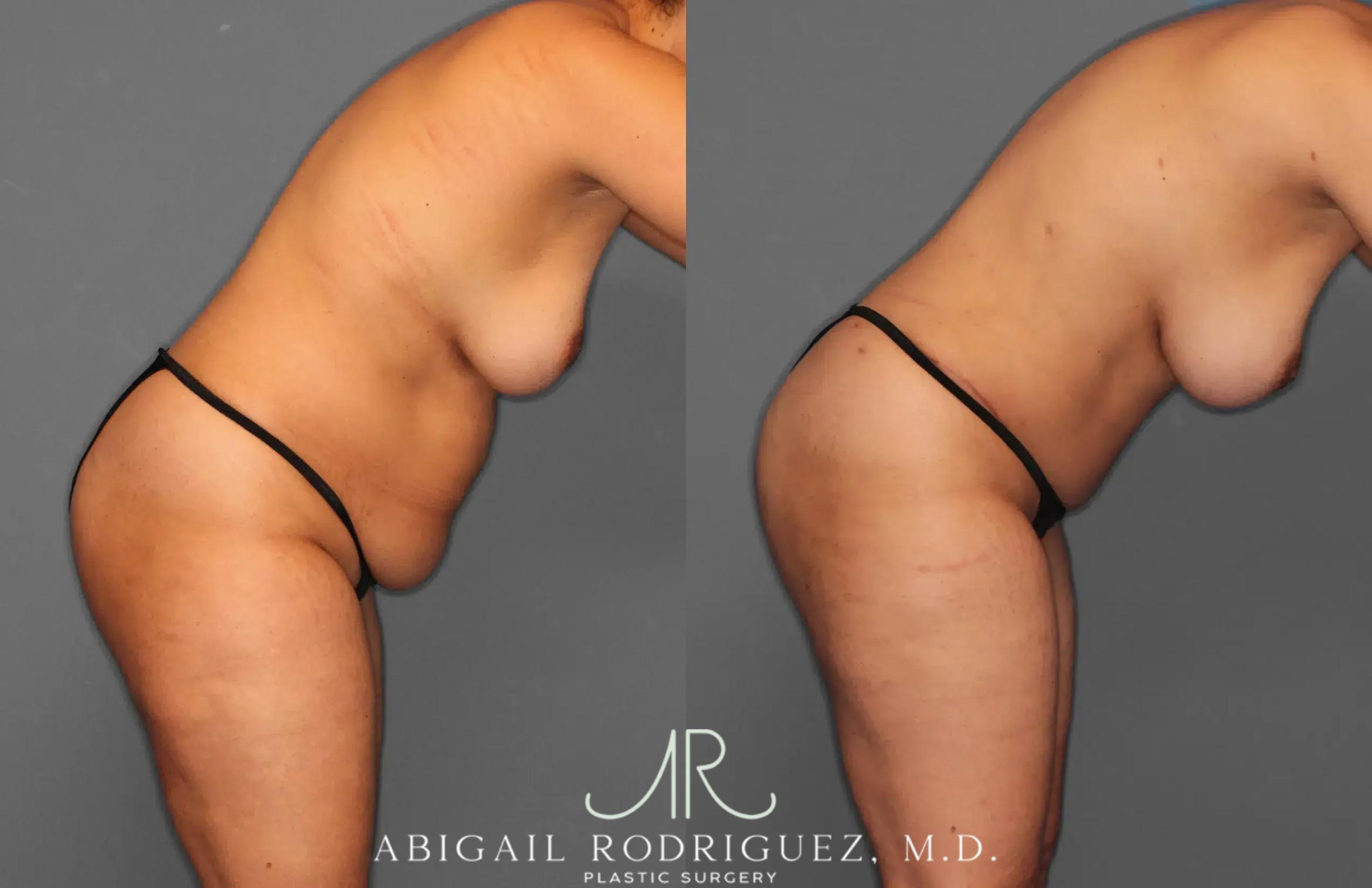 Before & After Tummy Tuck Case 259179 View 8 View in Houston, TX