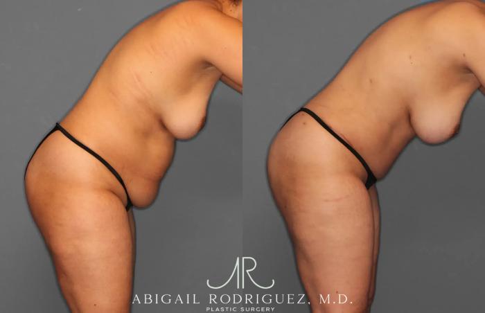 Before & After Tummy Tuck Case 259179 View 8 View in Houston, TX