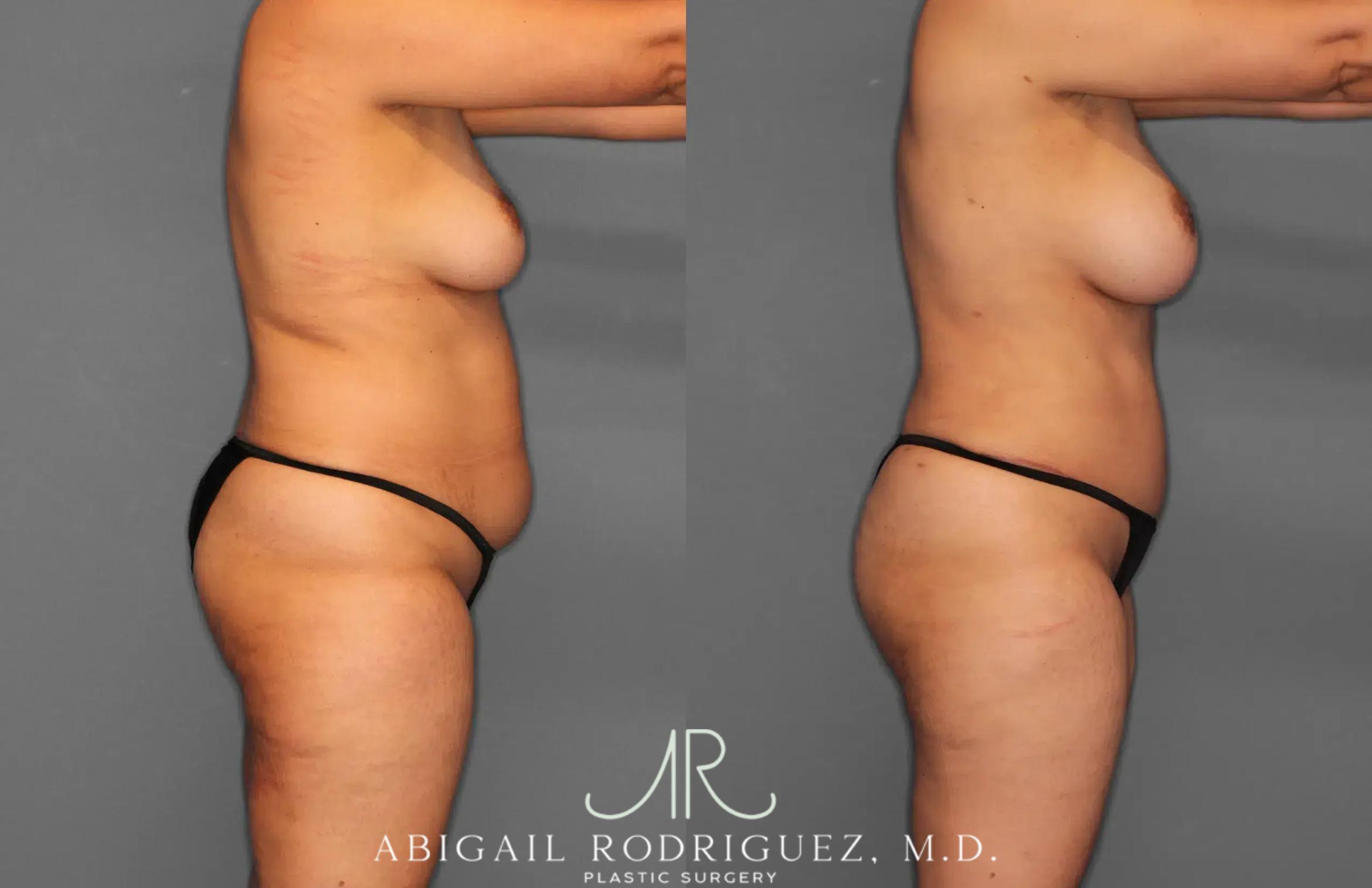 Before & After Tummy Tuck Case 259179 View 9 View in Houston, TX