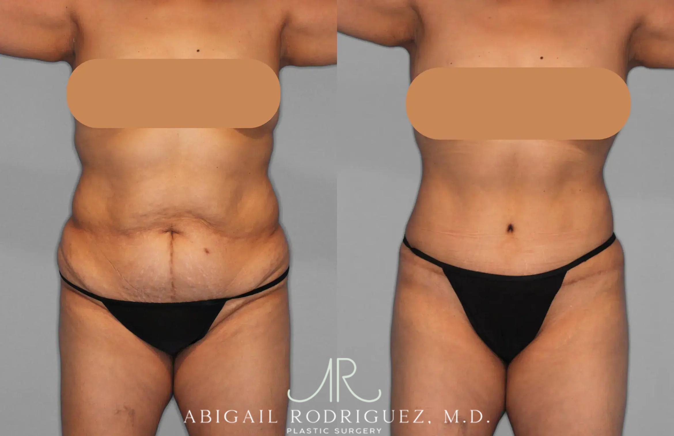 Before & After Tummy Tuck Case 259202 View 1 View in Houston, TX