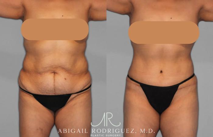 Before & After Tummy Tuck Case 259202 View 1 View in Houston, TX