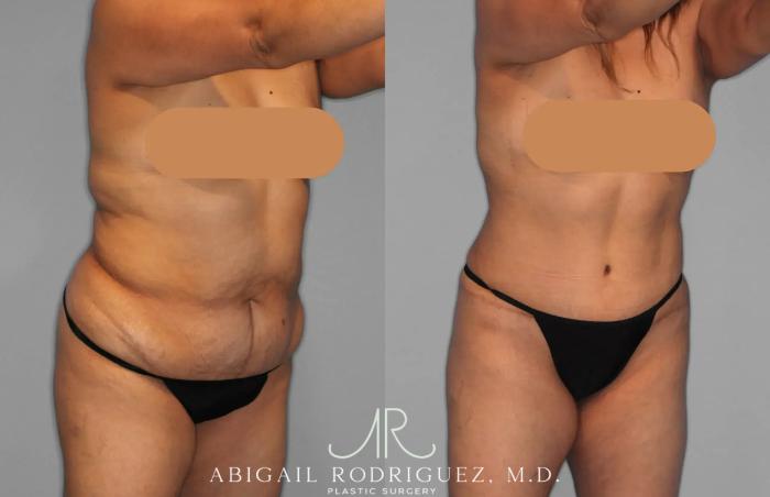 Before & After Tummy Tuck Case 259202 View 10 View in Houston, TX