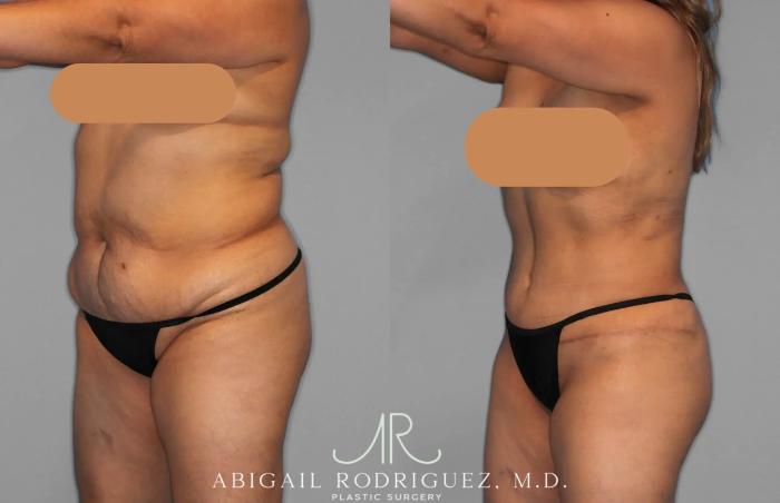 Before & After Tummy Tuck Case 259202 View 2 View in Houston, TX