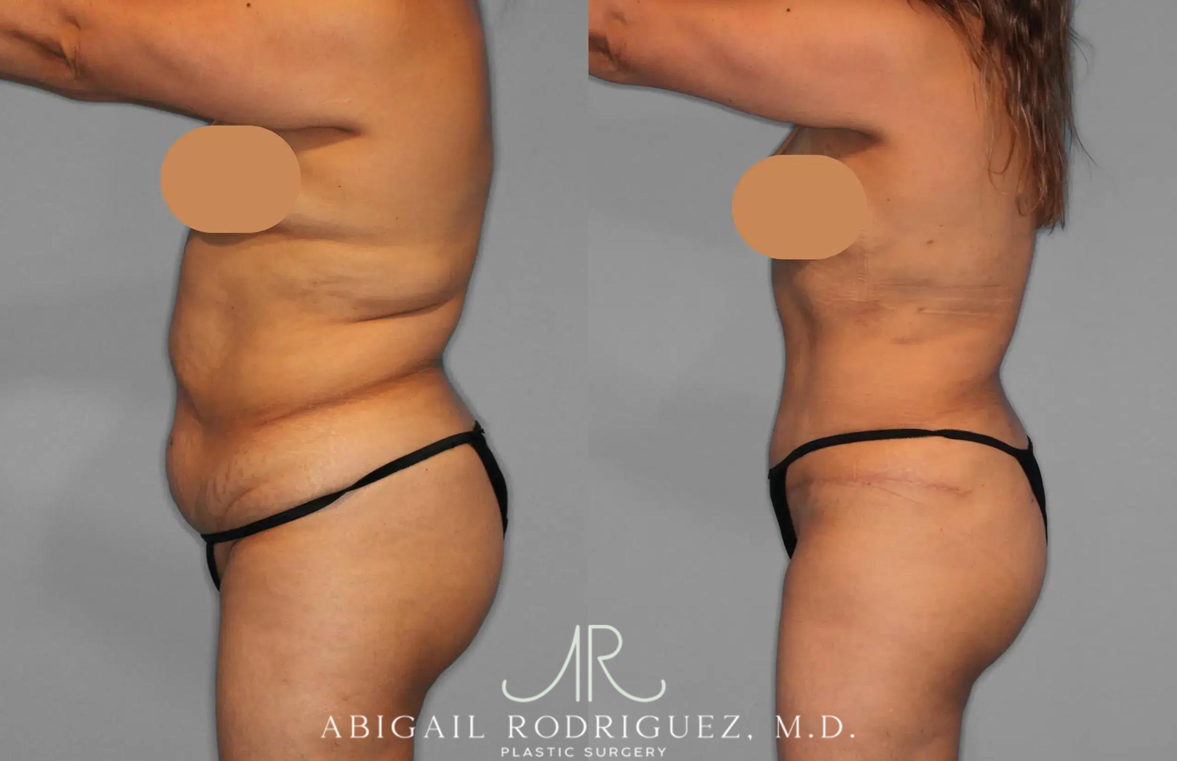 Before & After Tummy Tuck Case 259202 View 3 View in Houston, TX