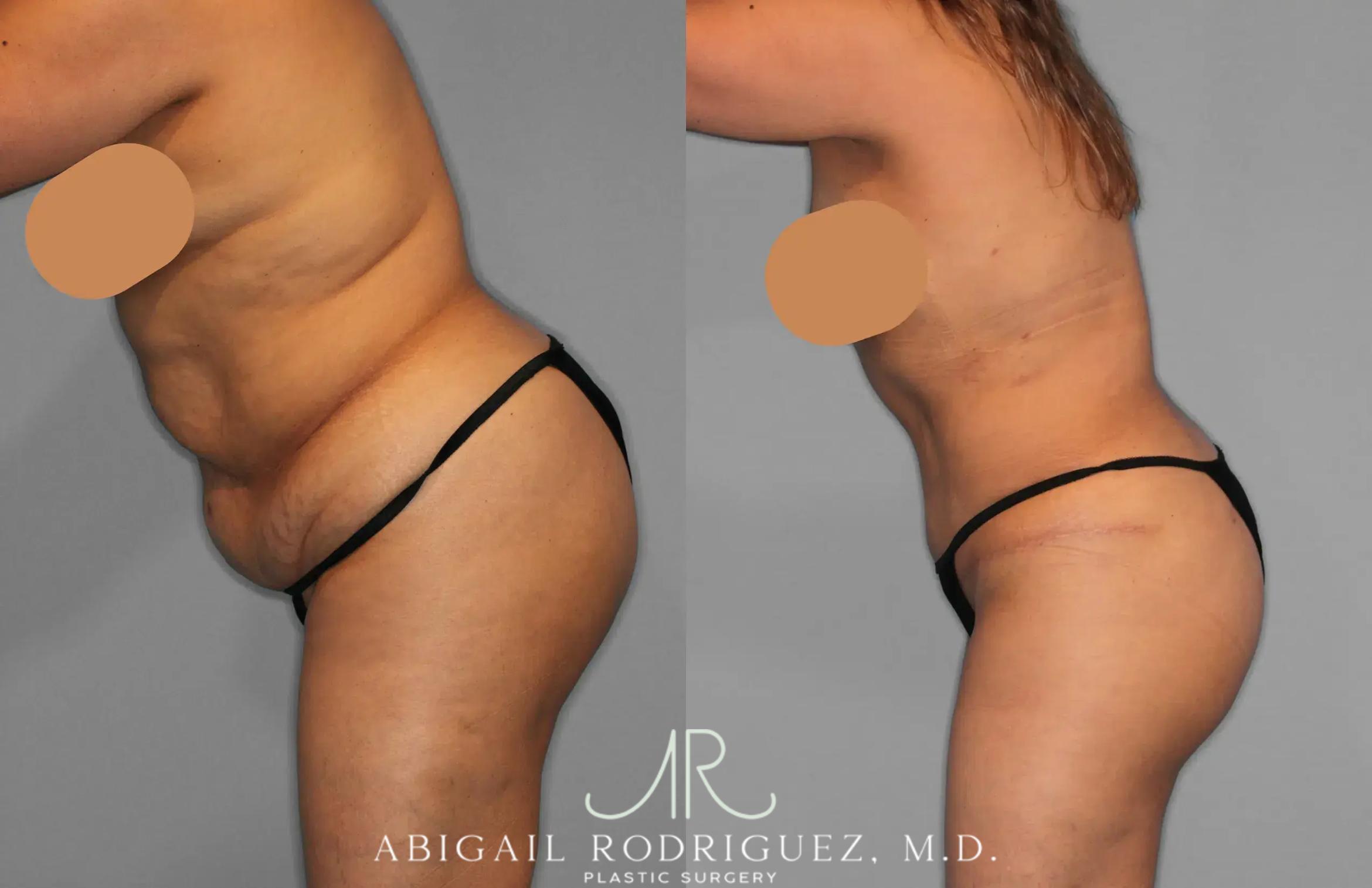 Before & After Tummy Tuck Case 259202 View 4 View in Houston, TX