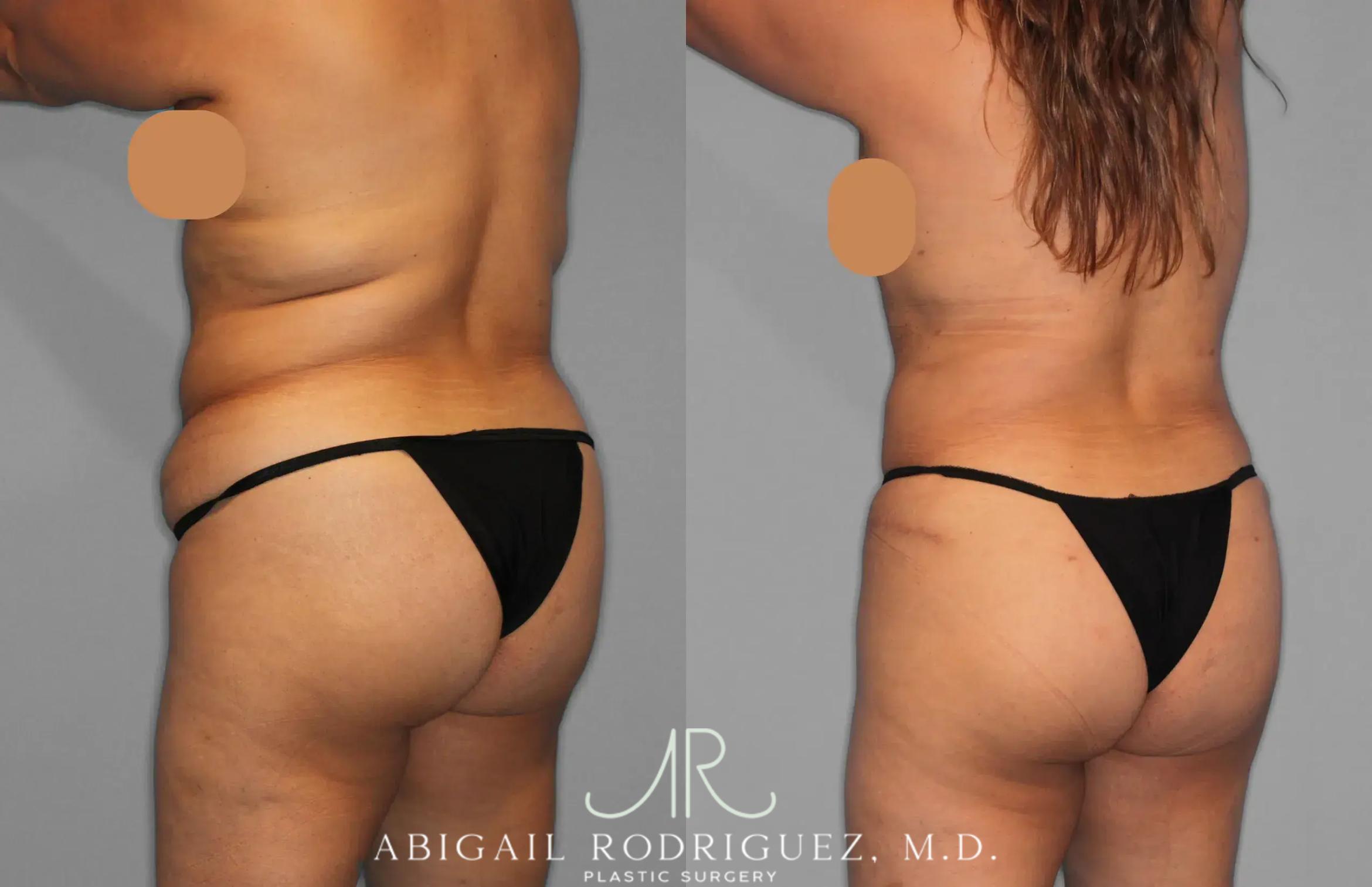 Before & After Tummy Tuck Case 259202 View 5 View in Houston, TX