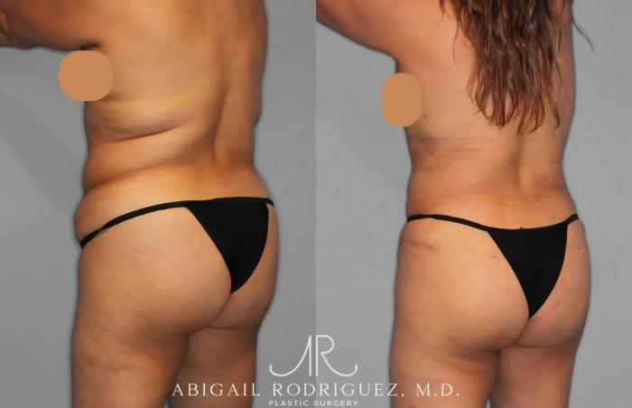 Before & After Tummy Tuck Case 259202 View 5 View in Houston, TX