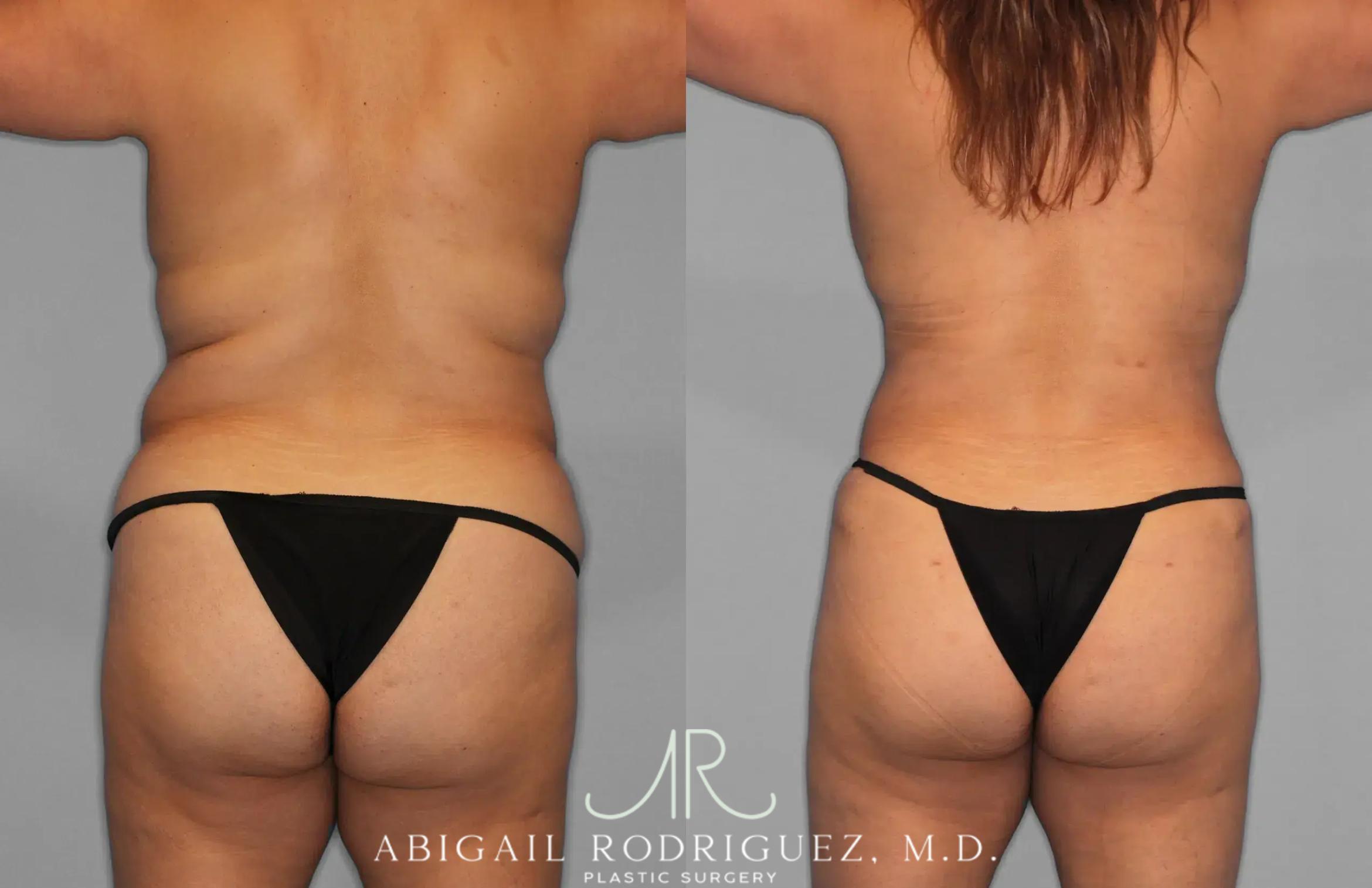 Before & After Tummy Tuck Case 259202 View 6 View in Houston, TX