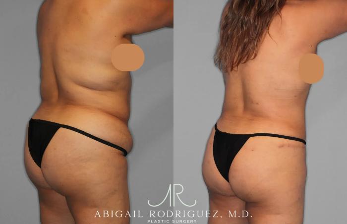 Before & After Tummy Tuck Case 259202 View 7 View in Houston, TX