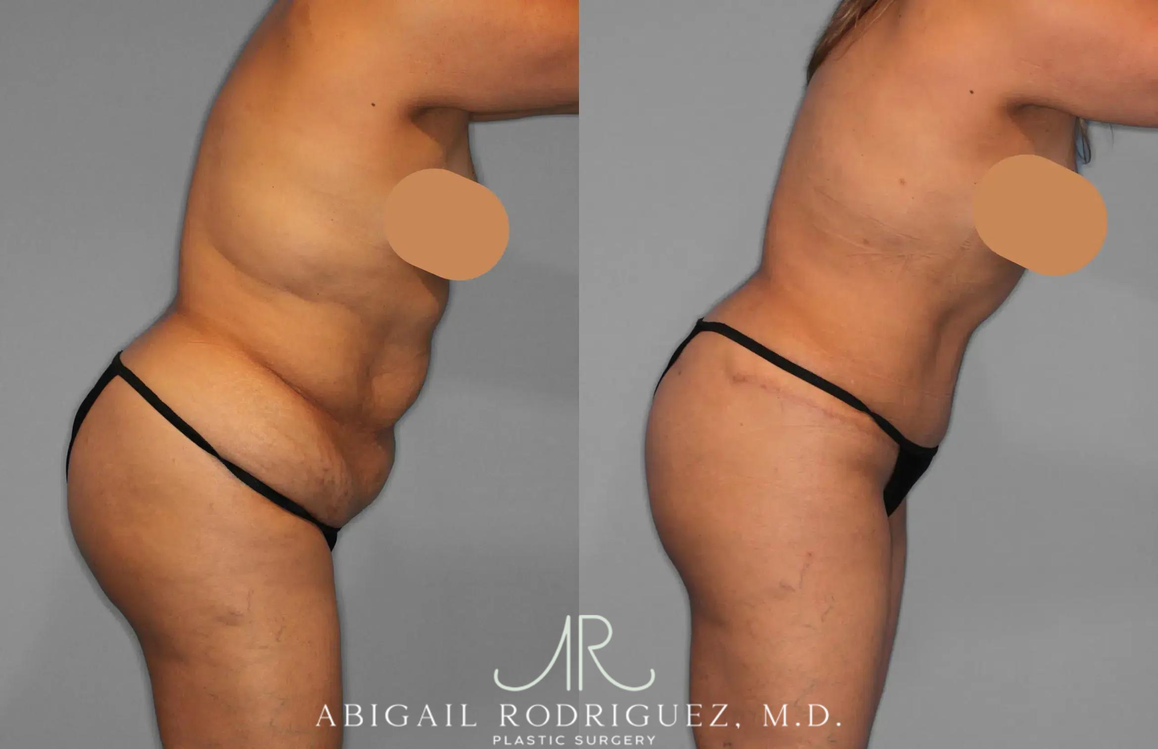 Before & After Tummy Tuck Case 259202 View 8 View in Houston, TX