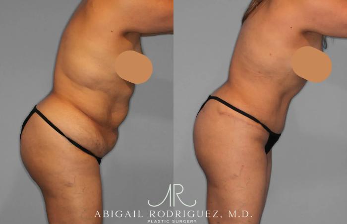 Before & After Tummy Tuck Case 259202 View 8 View in Houston, TX
