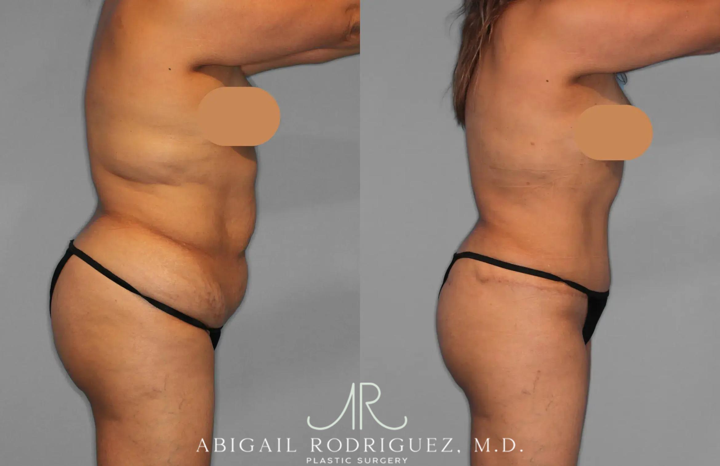 Before & After Tummy Tuck Case 259202 View 9 View in Houston, TX