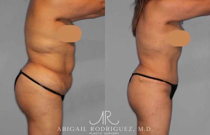 Before & After Tummy Tuck Case 259202 View 9 View in Houston, TX